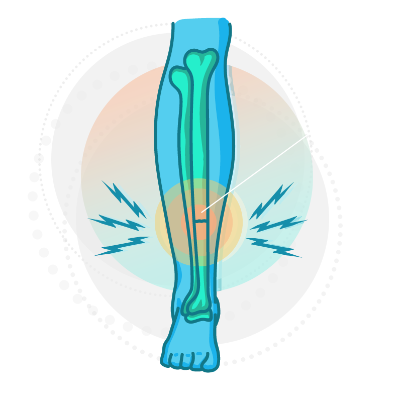 Graphic showing where a stress fracture is most likely to occur on the lower leg.