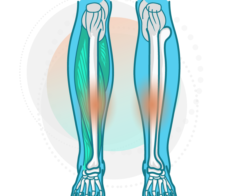 Graphic of bone structure inside lower leg, highlighting where shin splints often occur.