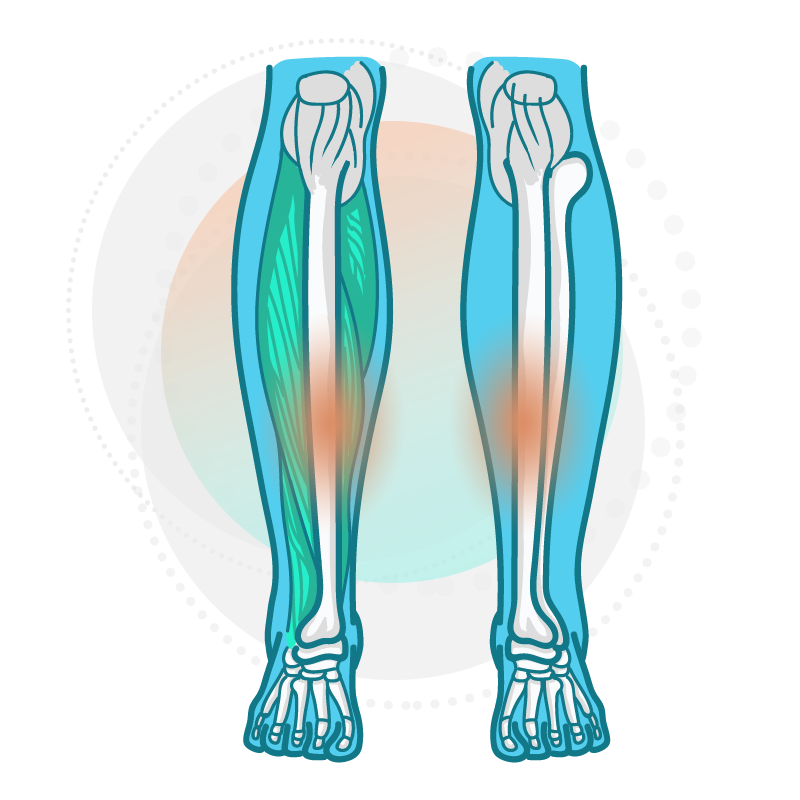 Graphic of bone structure inside lower leg, highlighting where shin splints often occur.