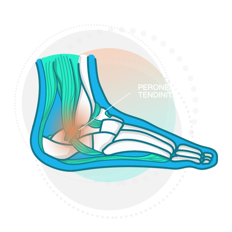 Graphic of foot showing bone and ligament structure highlighting where Peroneal Tendinitis is likely to occur.
